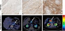 Immunohistochemical FAP Expression Reflects <sup>68</sup>Ga-FAPI PET Imaging Properties of Low- and High-Grade Intraductal Papillary Mucinous Neoplasms and Pancreatic Ductal Adenocarcinoma