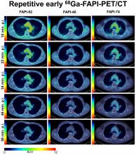 Repetitive Early <sup>68</sup>Ga-FAPI PET Acquisition Comparing <sup>68</sup>Ga-FAPI-02, <sup>68</sup>Ga-FAPI-46, and <sup>68</sup>Ga-FAPI-74: Methodologic and Diagnostic Implications for Malignant, Inflammatory/Reactive, and Degenerative Lesions