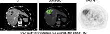 Prospective Phase II Trial of Prognostication by <sup>68</sup>Ga-NOTA-AE105 uPAR PET in Patients with Neuroendocrine Neoplasms: Implications for uPAR-Targeted Therapy