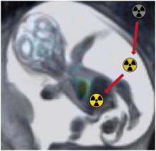 <sup>18</sup>F-FDG Fetal Dosimetry Calculated with PET/MRI