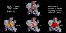 An Analysis of the Distribution of PSMA PET/CT–Positive Lymph Nodes and Their Coverage by Different Elective Nodal Radiation Volumes in Postoperative Prostate Cancer Patients